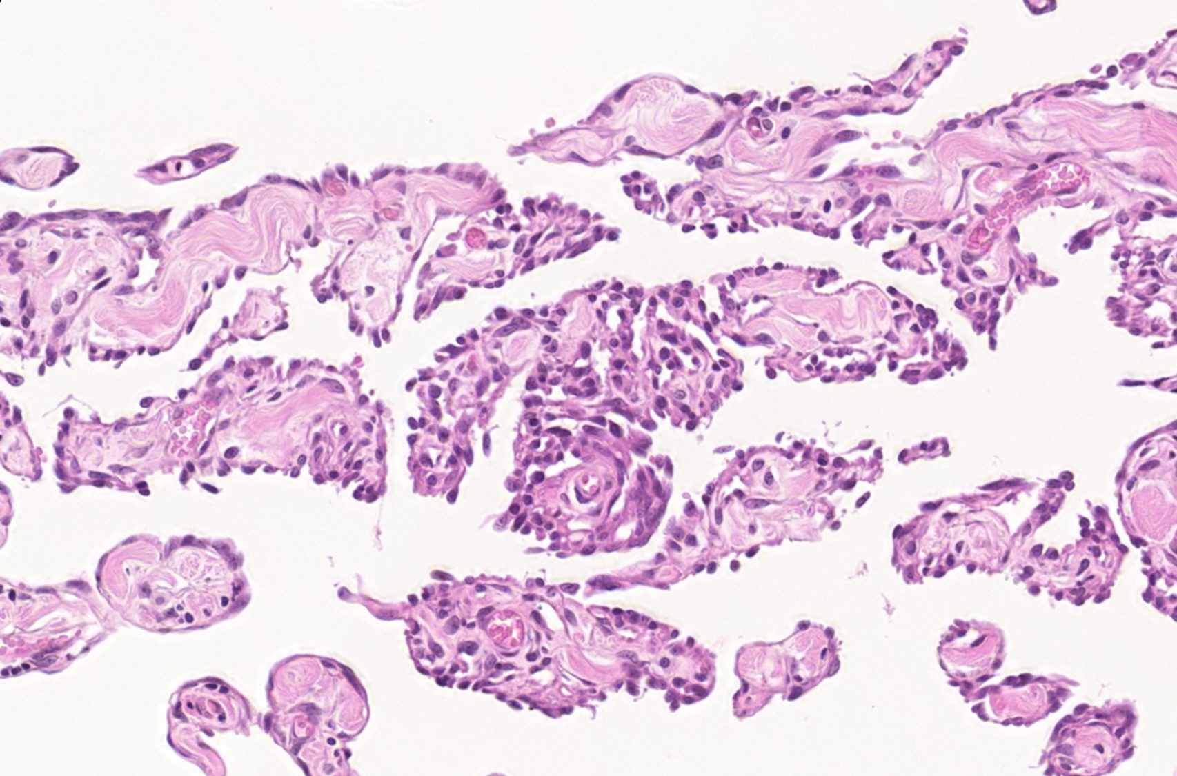 Lymphangiosarcoma in a cat