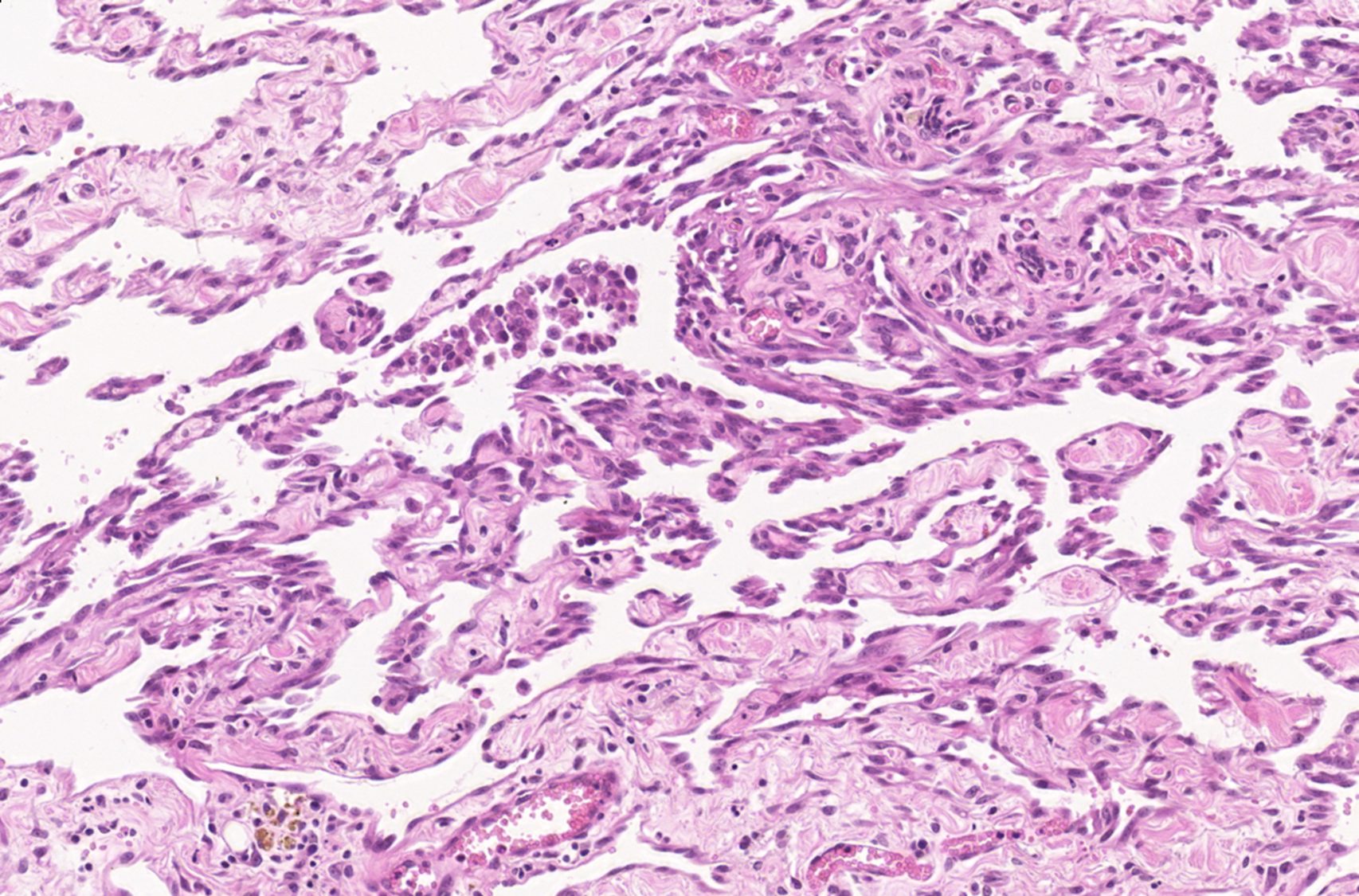 Lymphangiosarcoma in a cat