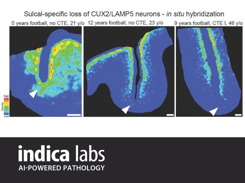 Multi-Omics Analysis Demonstrates Repetitive Head Impacts Induce Neuronal Loss and Neuroinflammation in Young Athletes