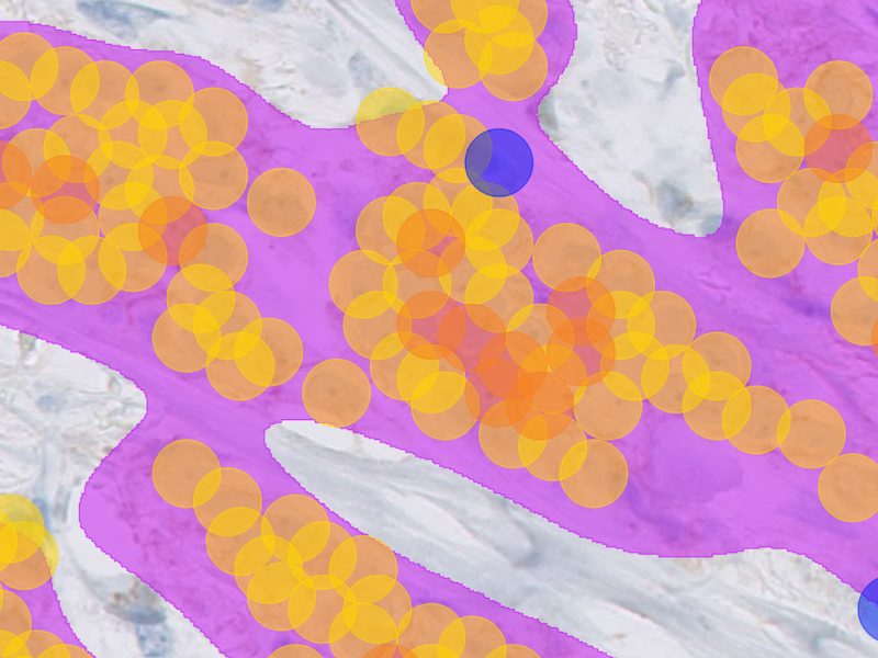 Evaluation of HER2-Low and Ultralow Status of Advanced Breast Carcinomas