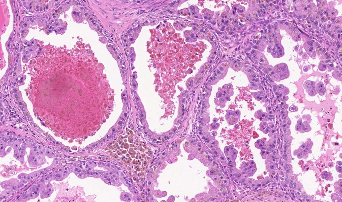 Irregular tubules, adenocarcinoma digit. h&e, 20x.