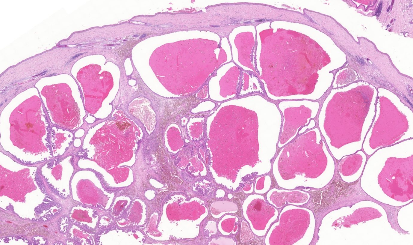 Irregular tubules, adenocarcinoma digit. h&e, 5x.