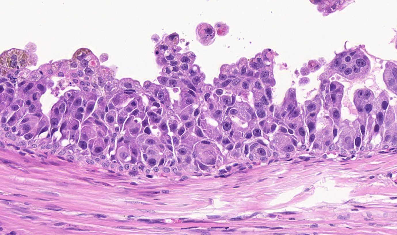 Marked atypia, adenocarcinoma digit. h&e, 40x.