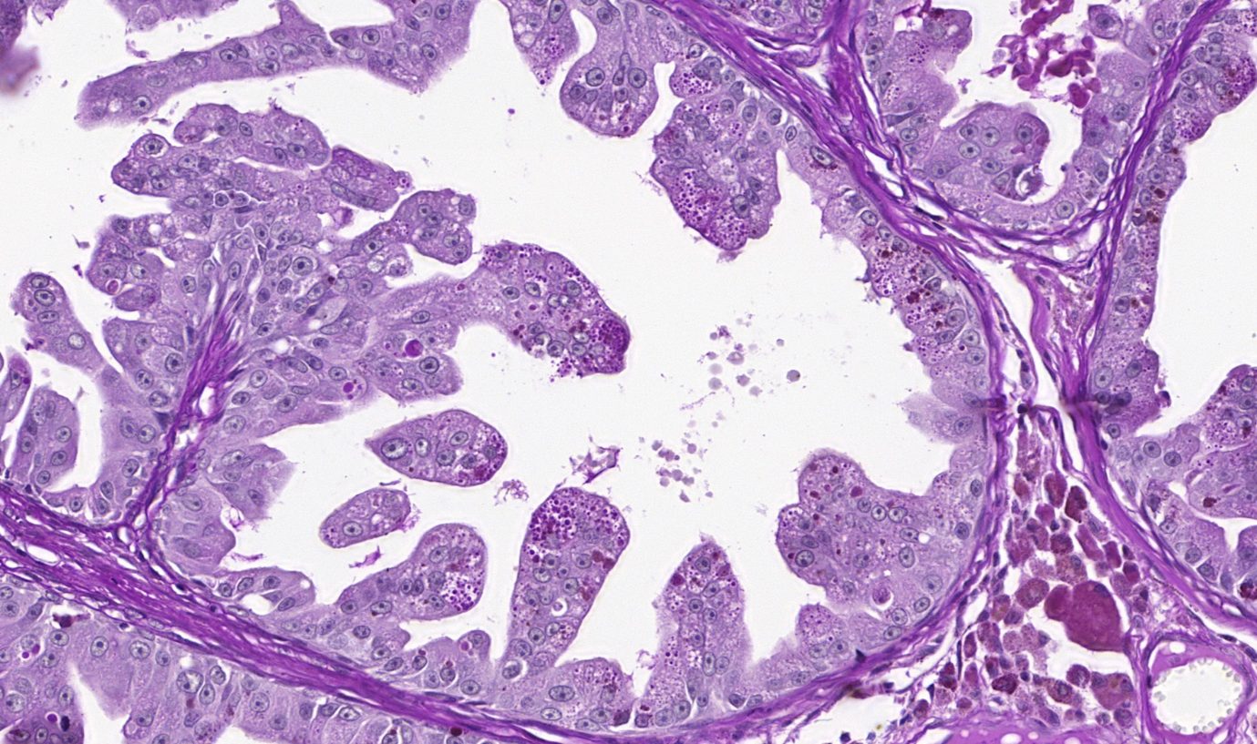 Positive for pas staining intracytoplasmic material adenocarcinoma digit. h&e, 40x.