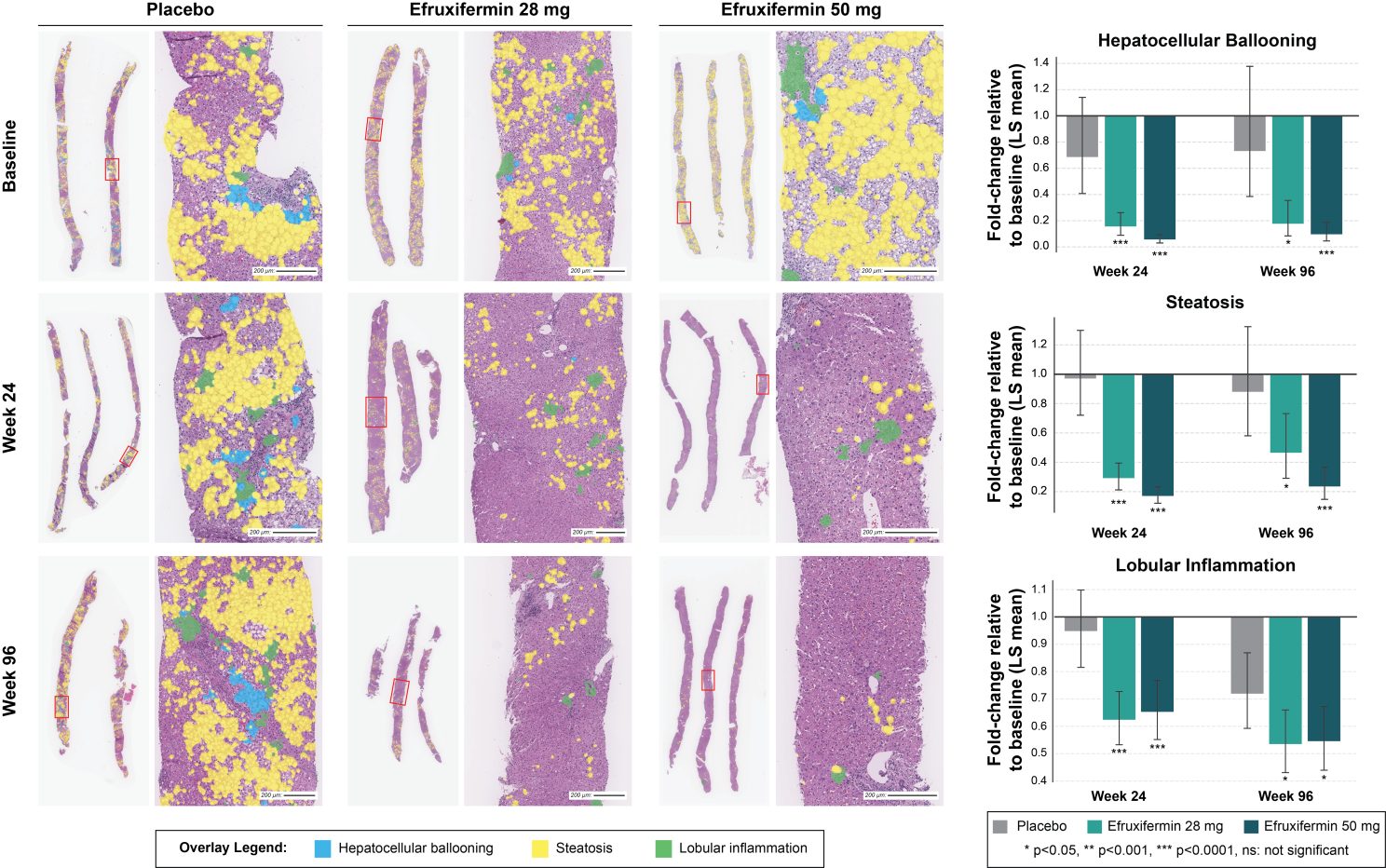 Figure 3. Improvements in LiverExplore-quantified MASH features with efruxifermin.(left) LiverExplore tissue overlays from representative biopsies across study arms and timepoints. (right) Fold change from baseline of LiverExplore-quantified relative tissue area features (out of total usable tissue) across study arms at weeks 24 and 96.