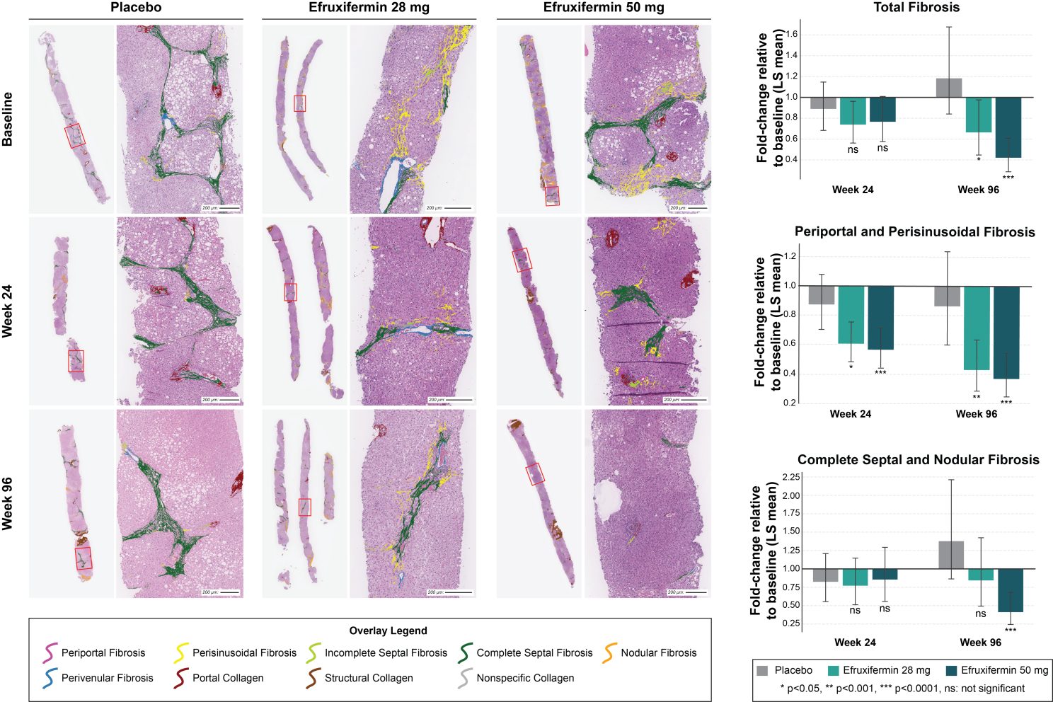 Figure 2. Improvements in LiverExplore-quantified fibrosis features with efruxifermin. (left) LiverExplore fibrosis overlays from representative biopsies across study arms and timepoints. (right) Fold change from baseline of LiverExplore-quantified fibrosis features across study arms at weeks 24 and 96.