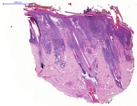 Fig. 1. skin, dog. hyperplastic and hyperkeratotic epidermis with subcorneal epidermal pustules and marked folliculitis and furunculosis