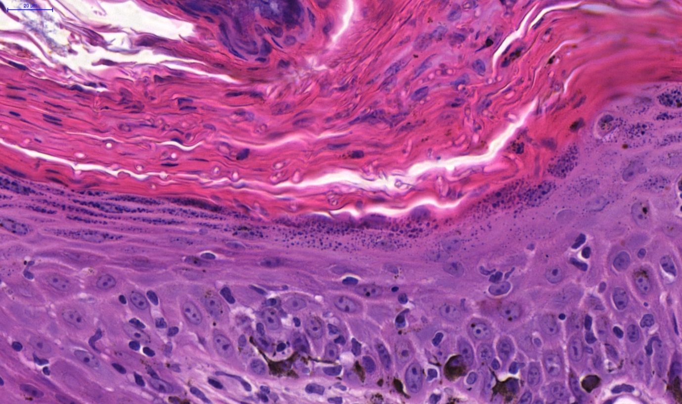Fig. 2. skin, dog. hyperplastic and hyperkeratotic epidermis with numerous basophilic or poorly stained arthrospores and rare hyphae within the keratin layers of the epidermis