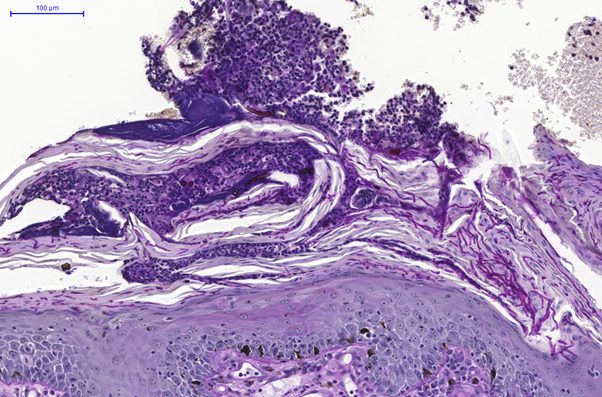 Fig. 4. skin, dog. hyperplastic and hyperkeratotic epidermis with numerous pas positive arthrospores and hyphae within the keratin layers