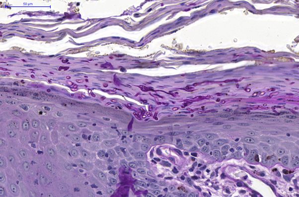 Fig. 5. skin, dog. hyperplastic and hyperkeratotic epidermis with numerous pas positive arthrospores and hyphae within the keratin layers