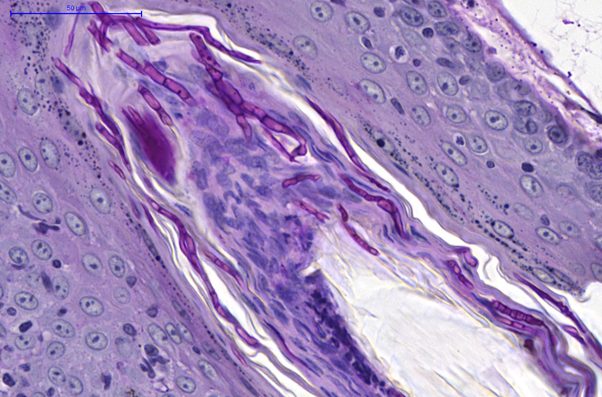 Fig. 6. skin, dog. numerous hyphae within the keratin layers of a hair follicle