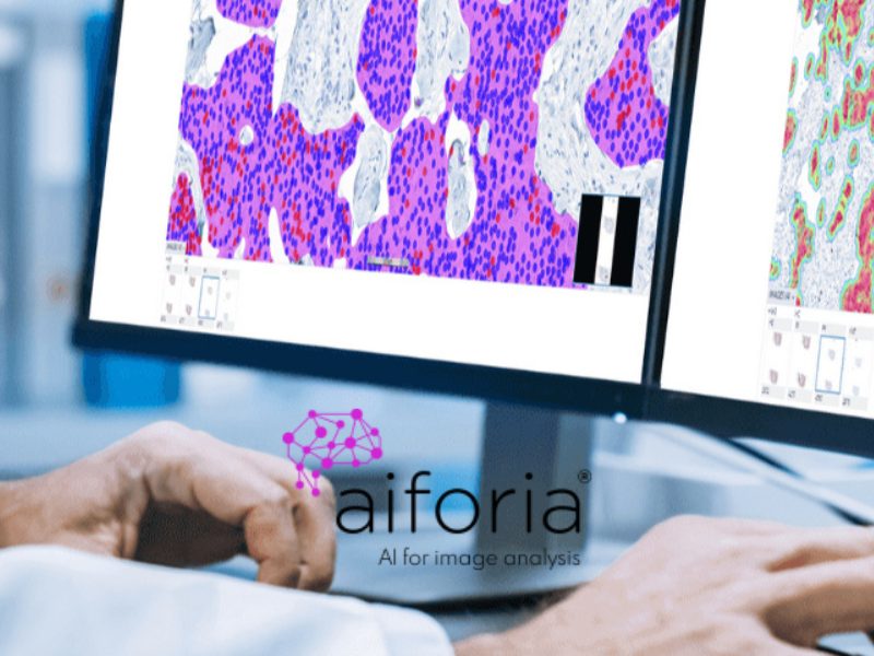 Optimizing the pathology workflow with aiforia® breast cancer suite