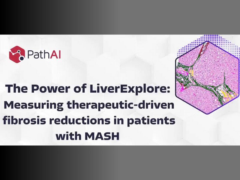 Realizing the power of liverexplore measuring therapeutic driven fibrosis reductions in patients with mash