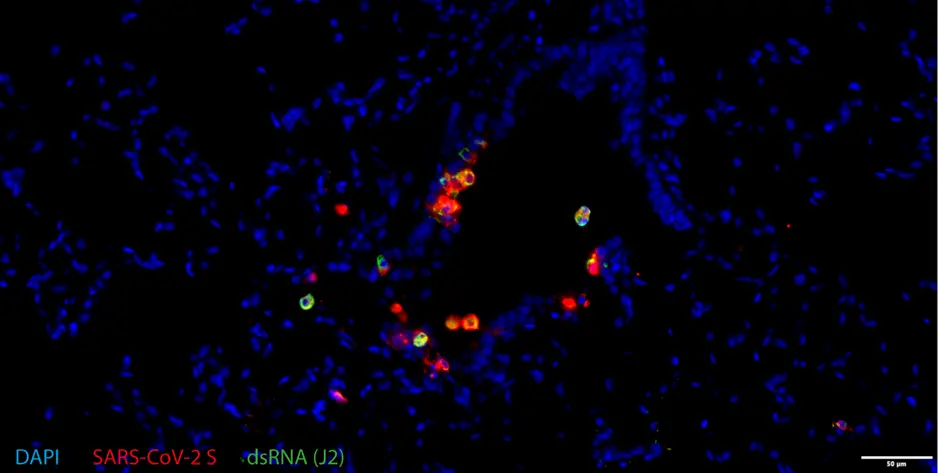 Figure 1. Double-stranded RNA (dsRNA, green) and SARS-CoV-2 spike protein (red) expression in hamsters infected with SARS-CoV-2 614G BavPat1 at four days post infection (dpi). Bar indicates 50 µm. Captured using the SLIDEVIEW VS200 slide scanner. Image courtesy of Dr. Georg Beythien.
