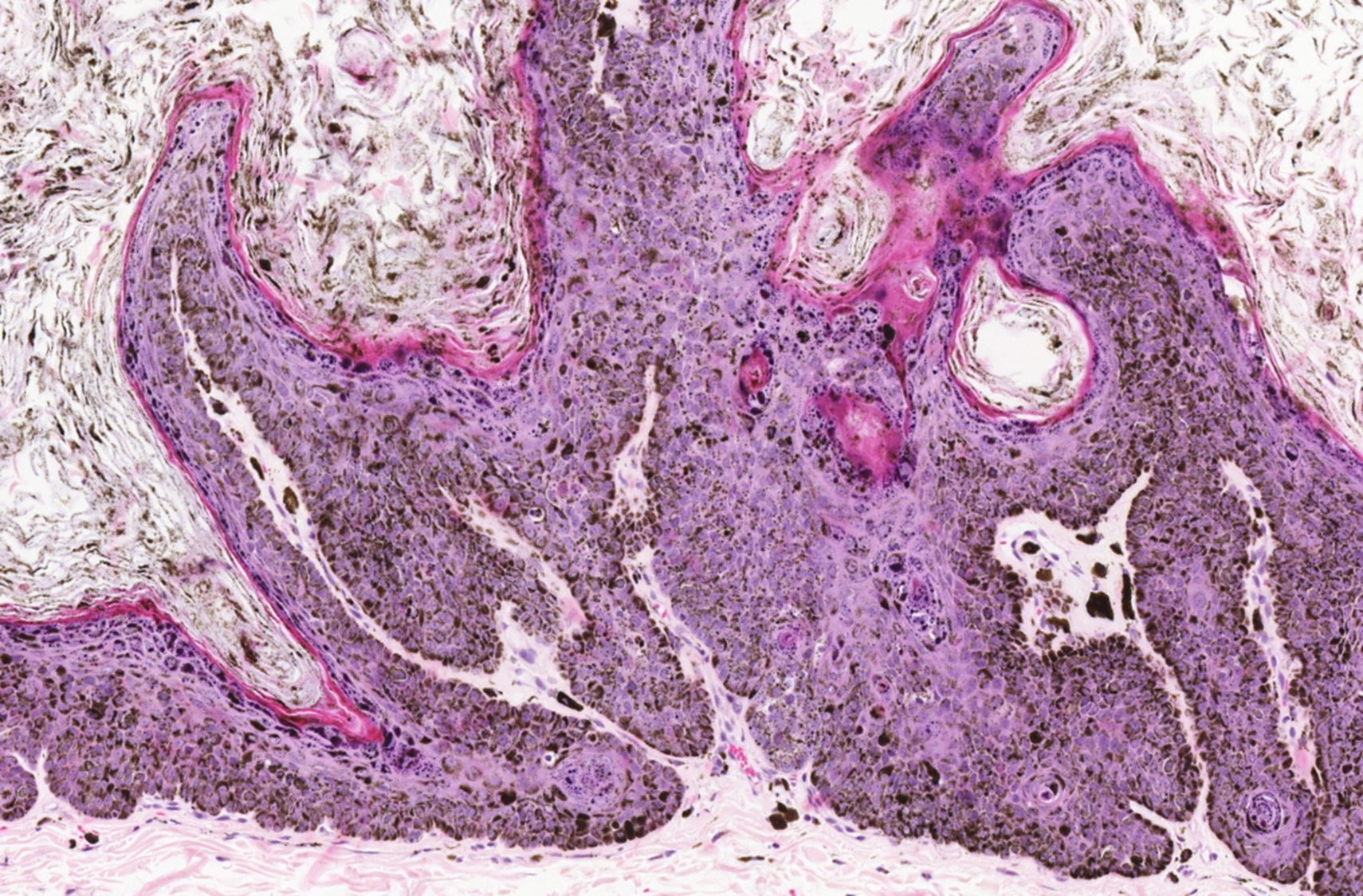 Canine pigmented viral plaque
