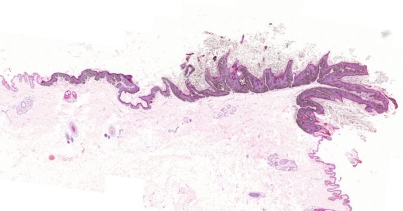 Canine pigmented viral plaque