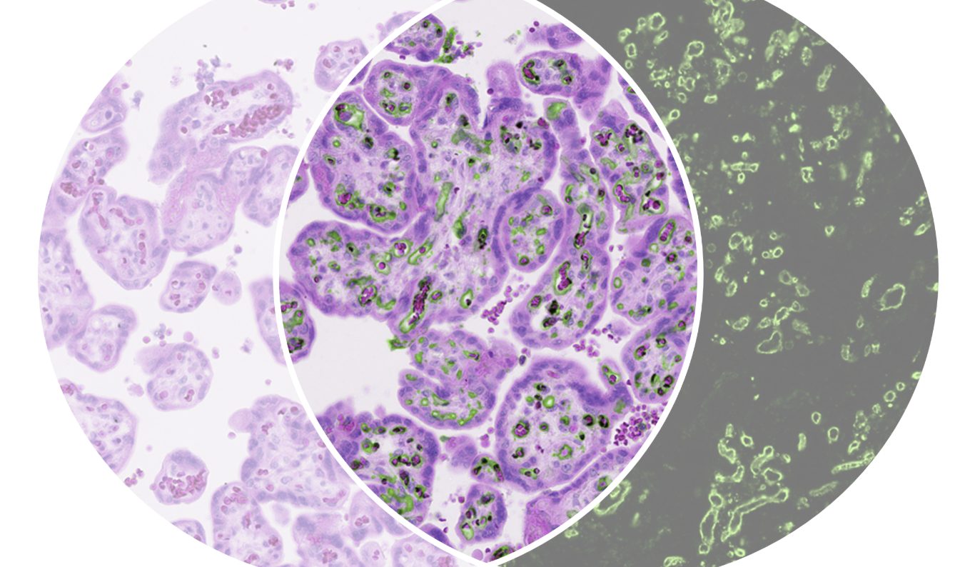 The same image can be viewed in brightfield, UCNP-mode or combined Full biomarker and morphology separation