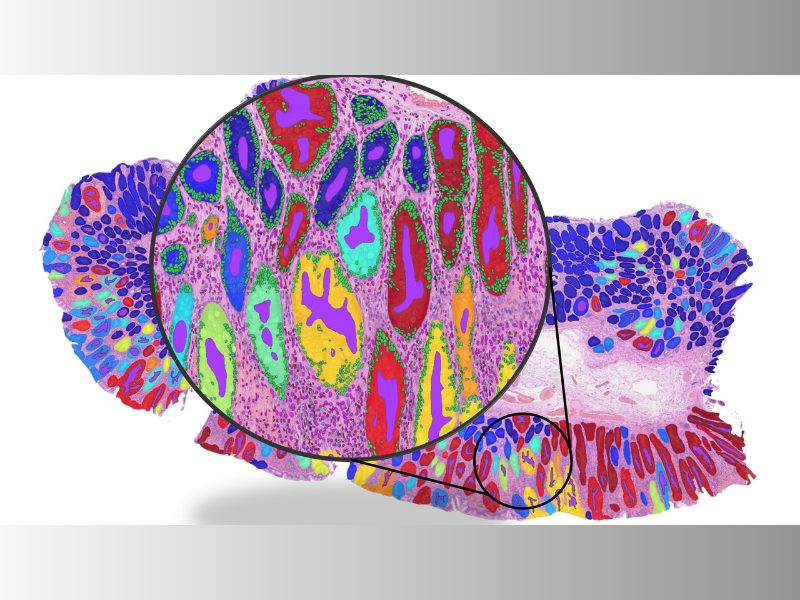 AI Cancer Tools Risk “Shortcut Learning” Rather Than Detecting True Biology