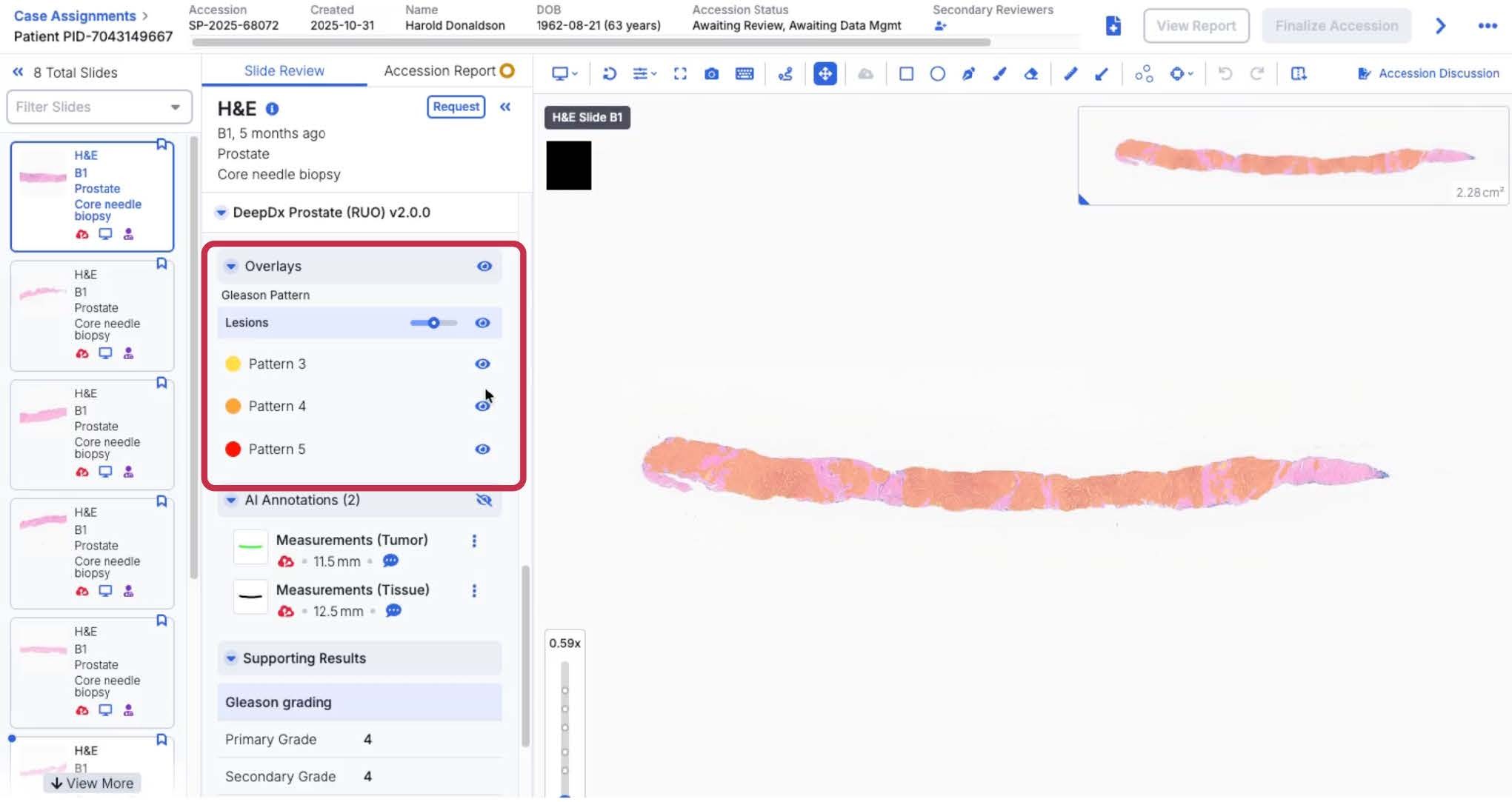 Figure 3 - DeepDx Prostate, developed by Deep Bio, running on PathAI's AISight IMS Platform