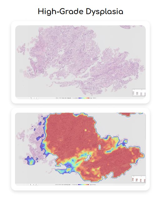 High Grade Dysplasia