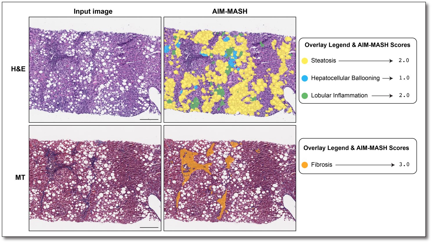 Figure 1. Representative AIM-MASH overlays and associated scores. Scale bar indicates 200 μm. H&E: hematoxylin and eosin; MT: Masson Trichrome.