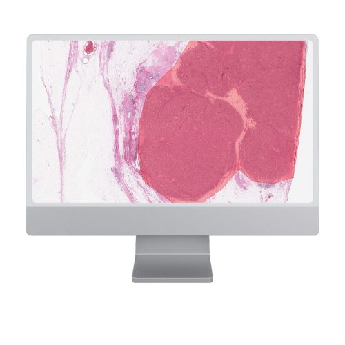 DeepDx® Breast – Resection