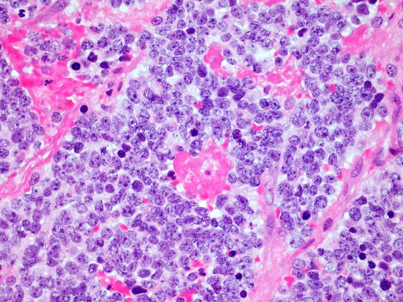 A Quantum Mechanics Approach to Artificial Intelligence Can Improve Cancer Outcomes