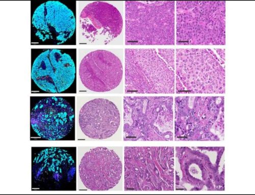 New Topology-based Biomarkers May Improve Breast Cancer Prediction